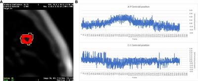 Motion and dosimetric criteria for selecting gating technique for apical lung lesions in magnetic resonance guided radiotherapy